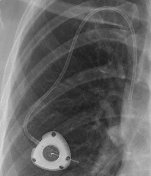 X-Ray of Powerport implanted in someone's chest